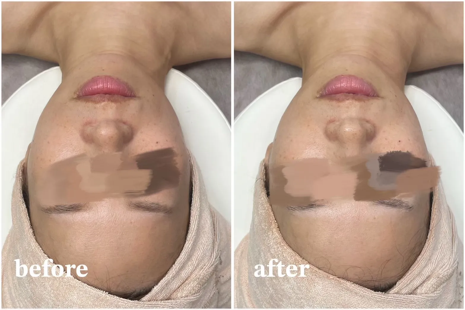 20代女性ララピールのビフォーアフター