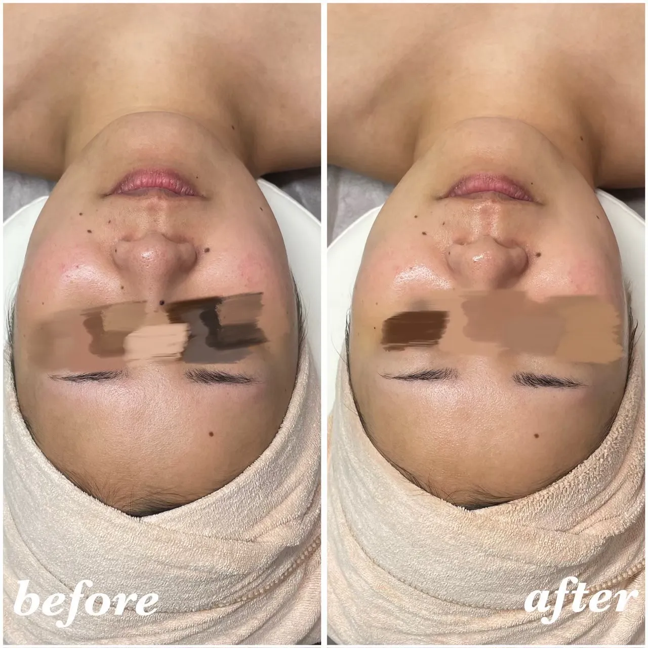 30代女性ララピールのビフォーアフター